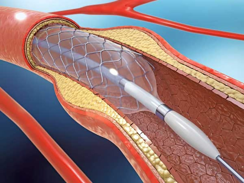 interventional medical device